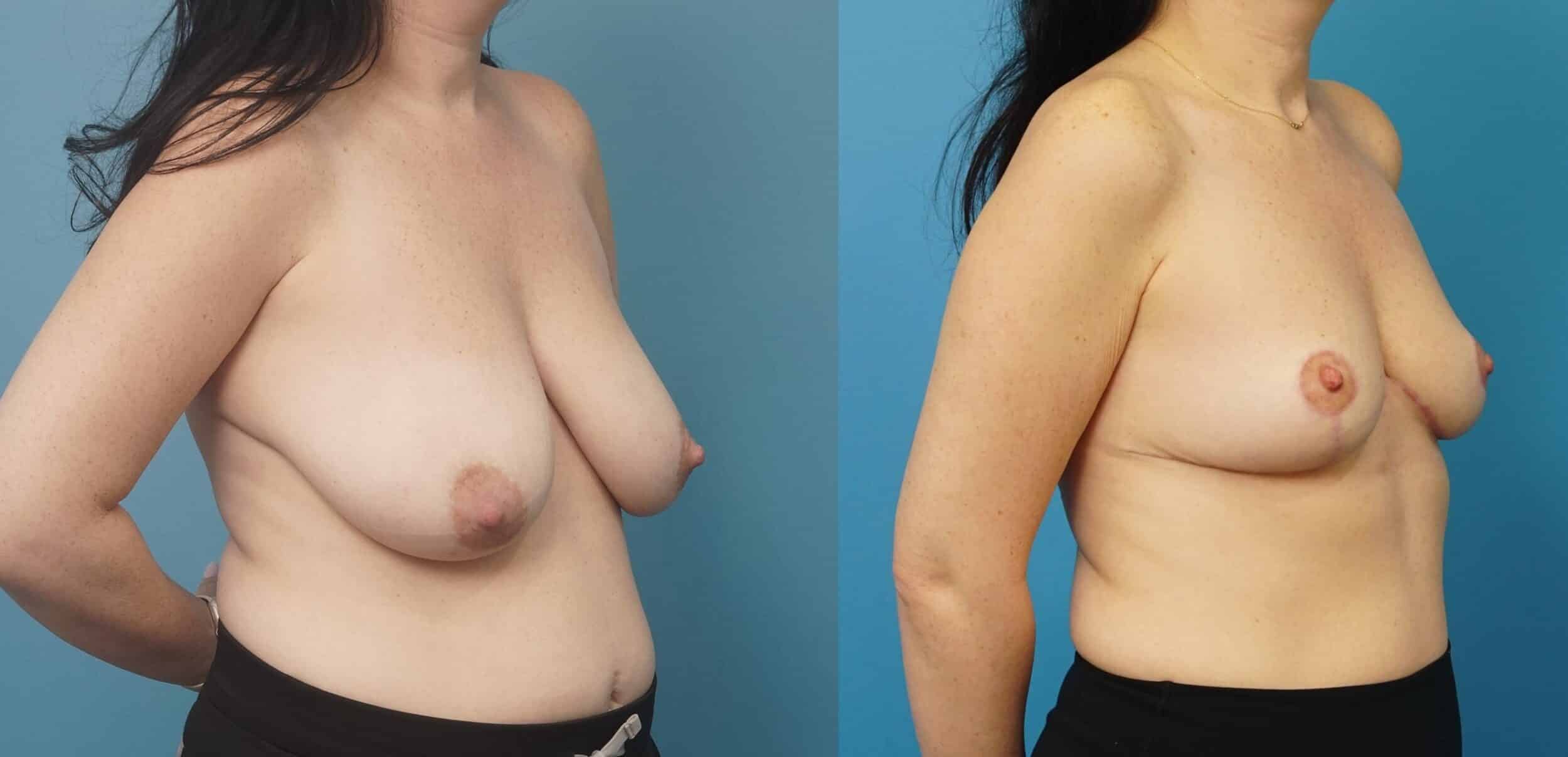 Before and After Image: Breast Reduction and Lift - right-front-oblique