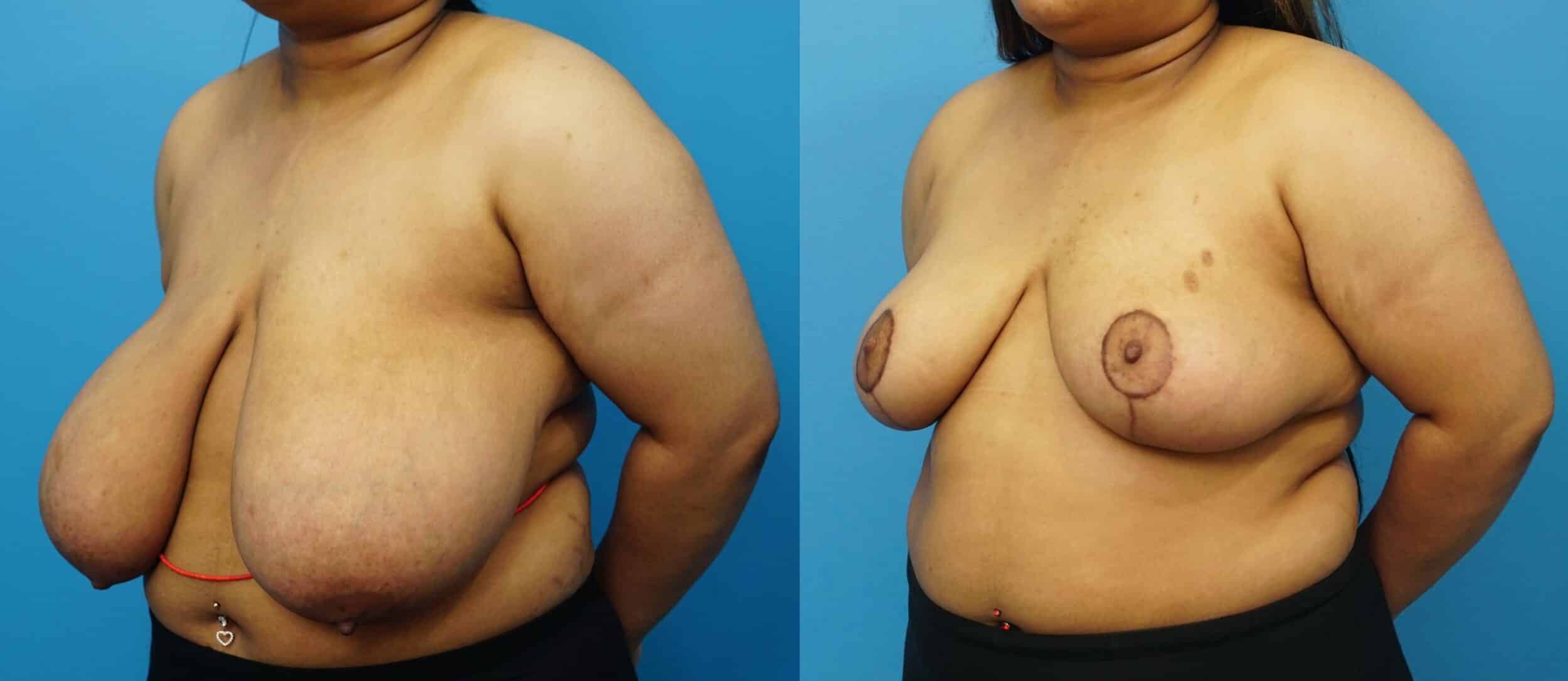 Before and After Image: Breast Reduction and Lift - left-front-oblique