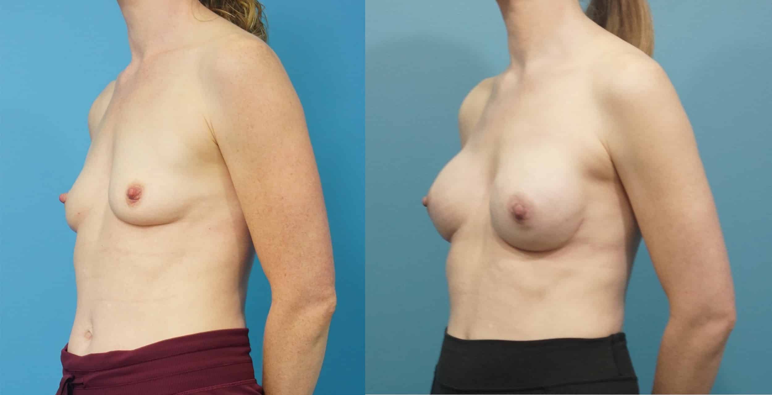 Before and After Image: Breast Reconstruction with Tissue Expander - left-front-oblique