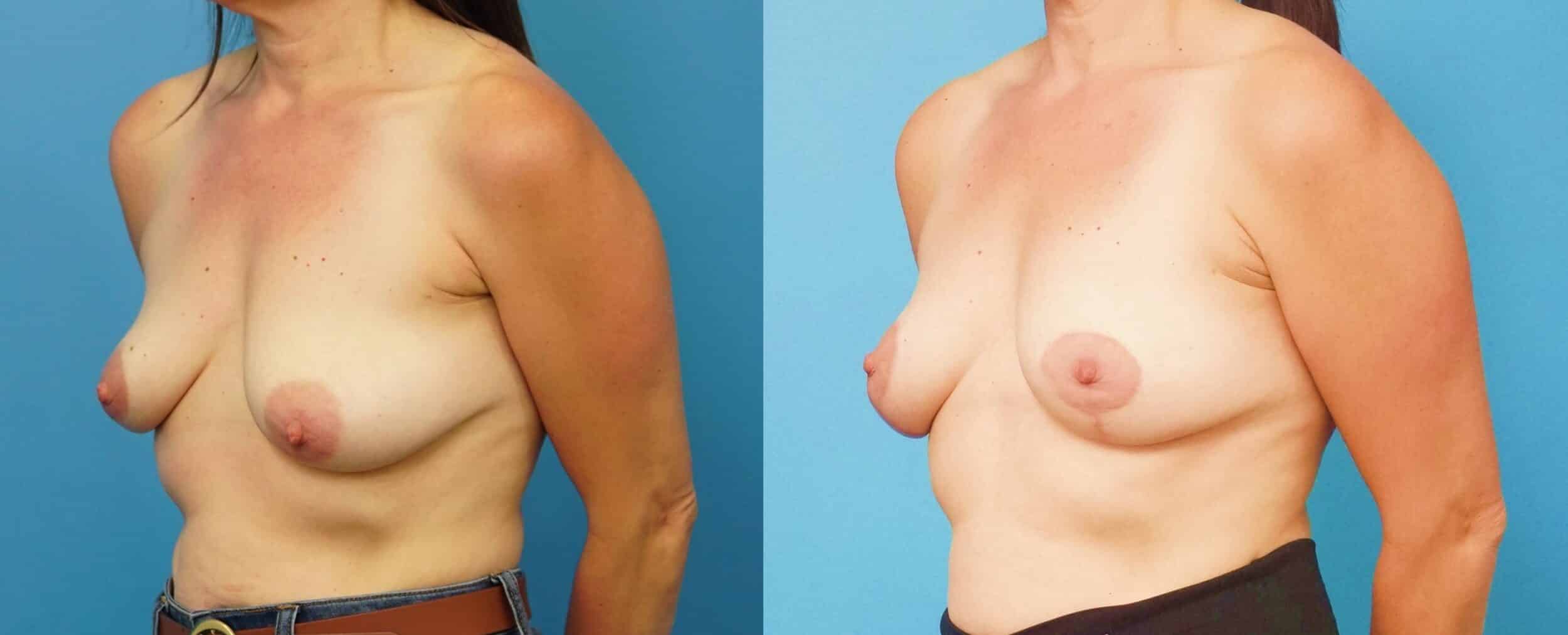 Before and After Image: Oncoplastic Breast Lift - left-front-oblique
