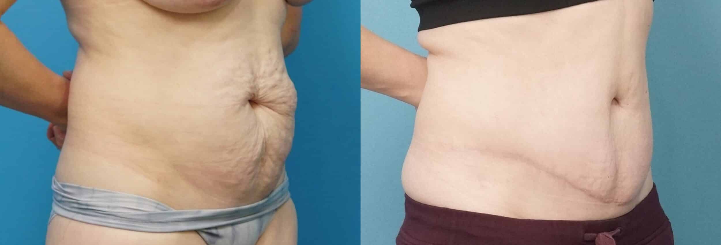 Before and After Image: Abdominoplasty with Flank Liposuction - right-front-oblique