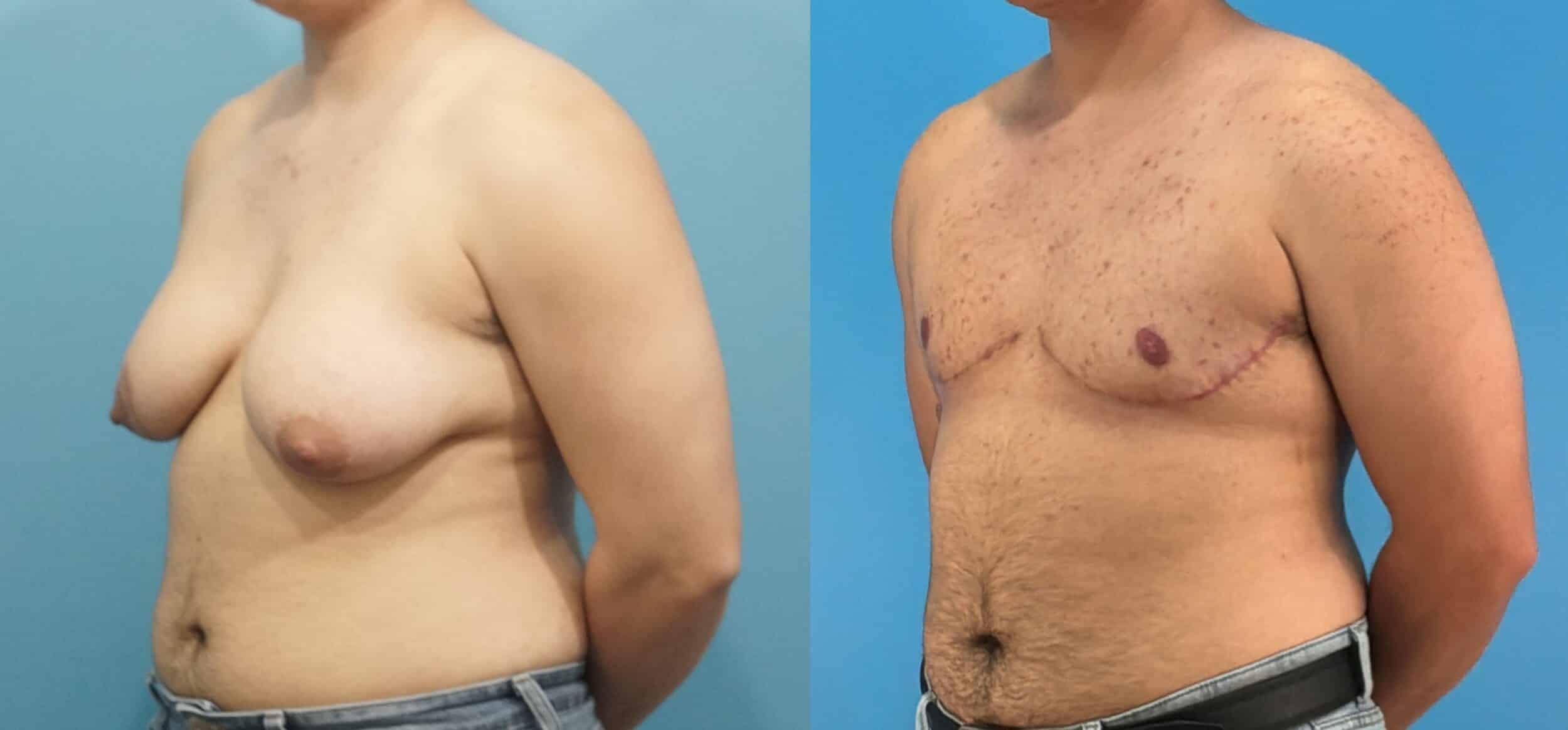 Before and After Image: Gender Affirming Mastectomy - front