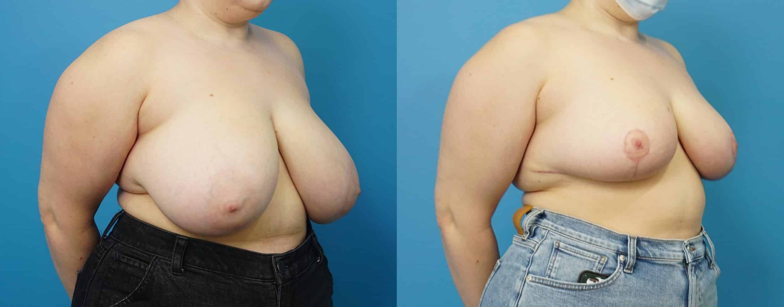 Before and After Image: Breast Reduction and Lift - right-front-oblique