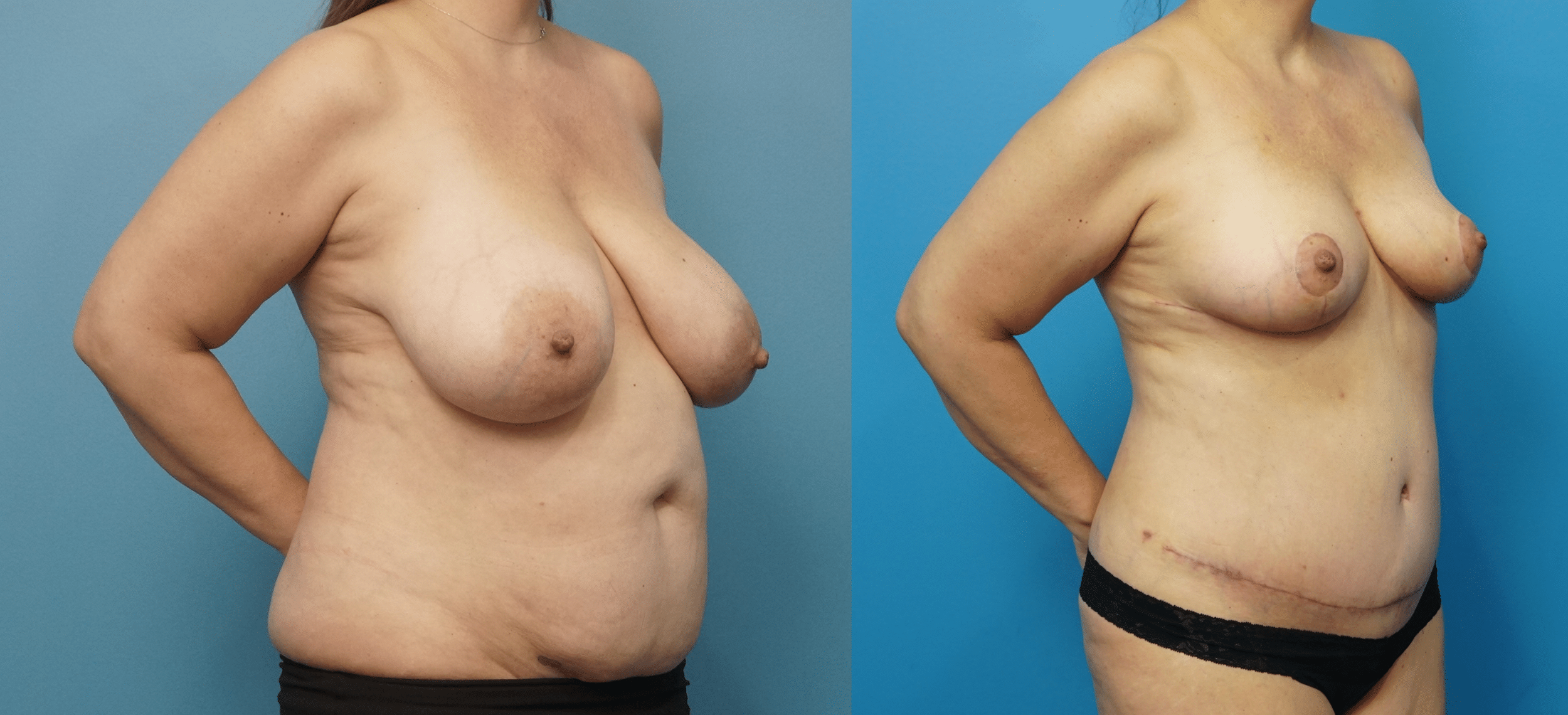 Before and After Image: Breast Reduction and Lift with Abdominoplasty and Flank Liposuction - right-front-oblique